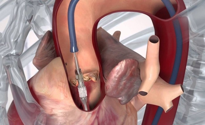 L'affaire des stents périmés : éviter toute stigmatisation L'affaire des stents périmés : éviter toute stigmatisation