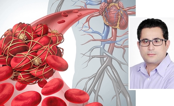 Le Covid 19 est une maladie thromboembolique.